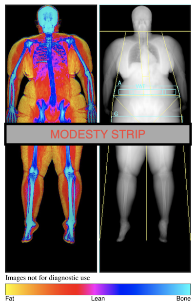 DEXA scan image of body